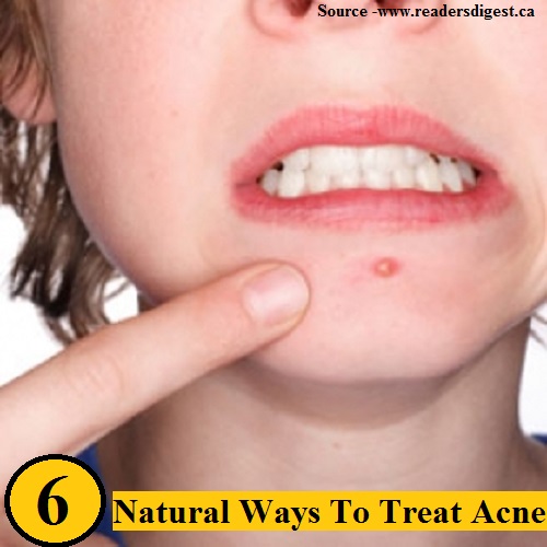 6 Natural Ways To Treat Acne